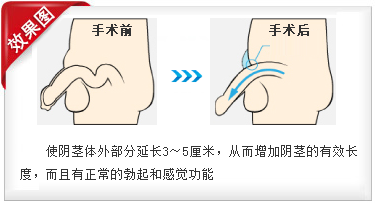 男人阴茎可以延长吗